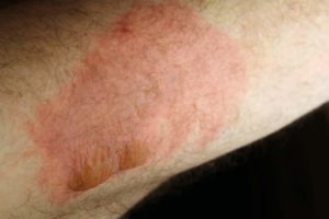 Texas Burn Injury Attorneys
